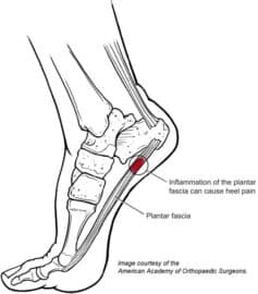 Plantar faciiatis 500x569 1