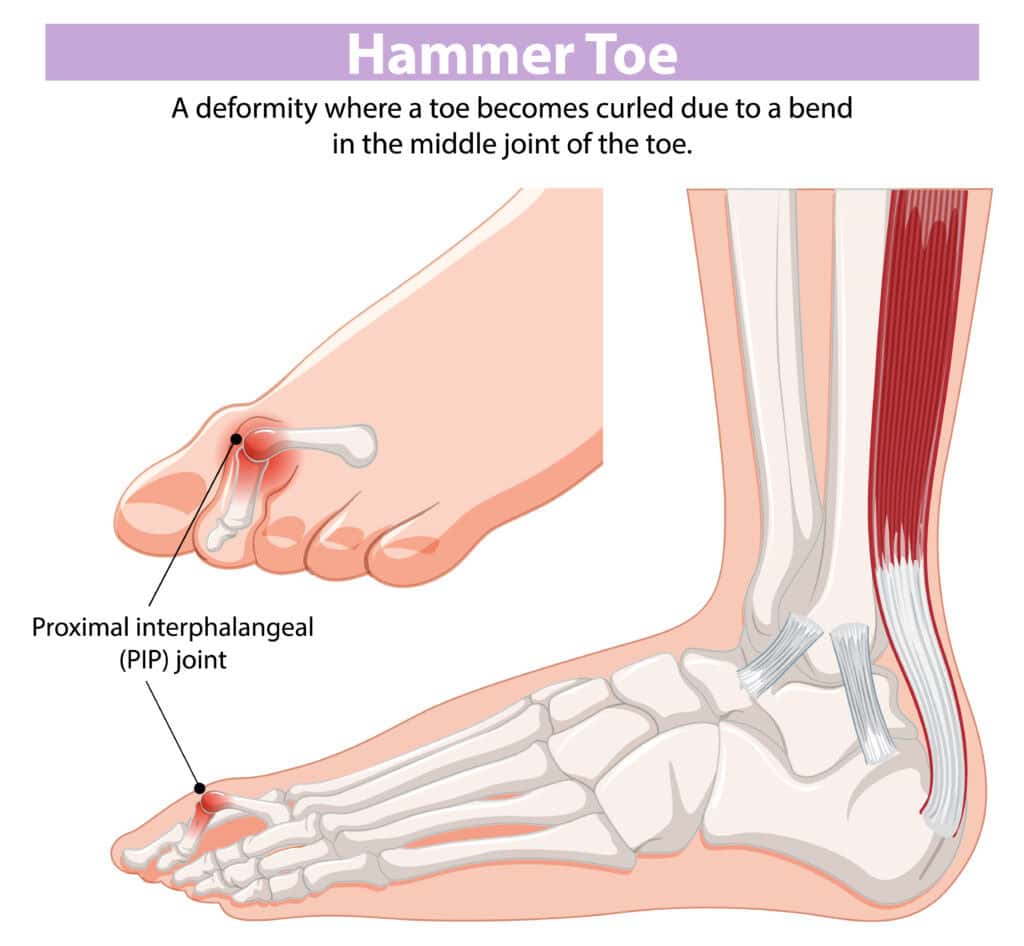 hammer toe