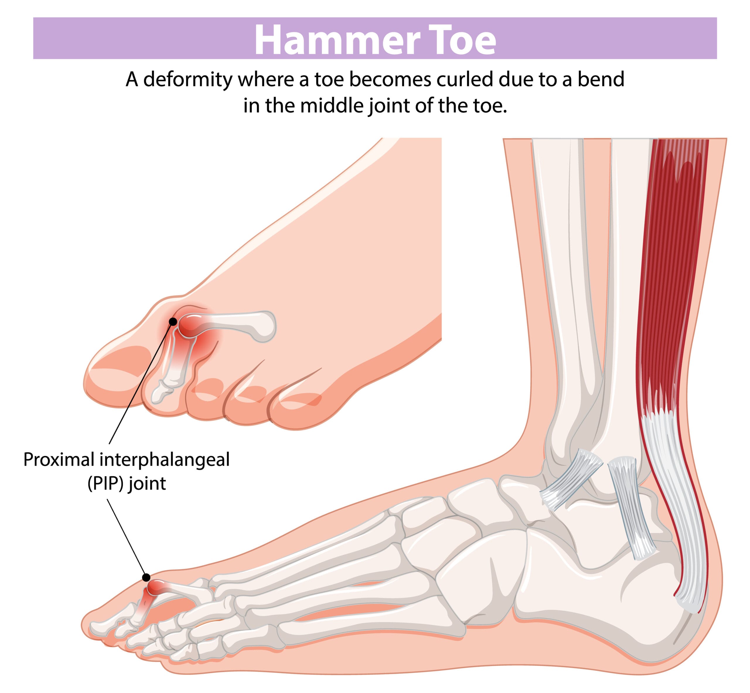 hammer toe