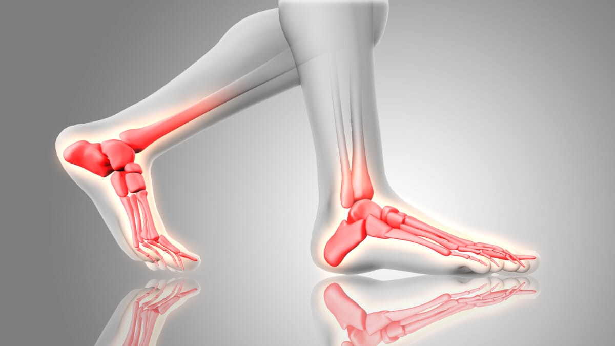 plantar fasciitis foot arch pain