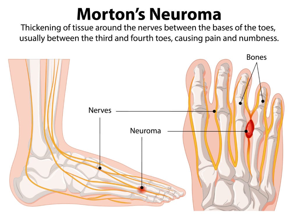morton's neuroma