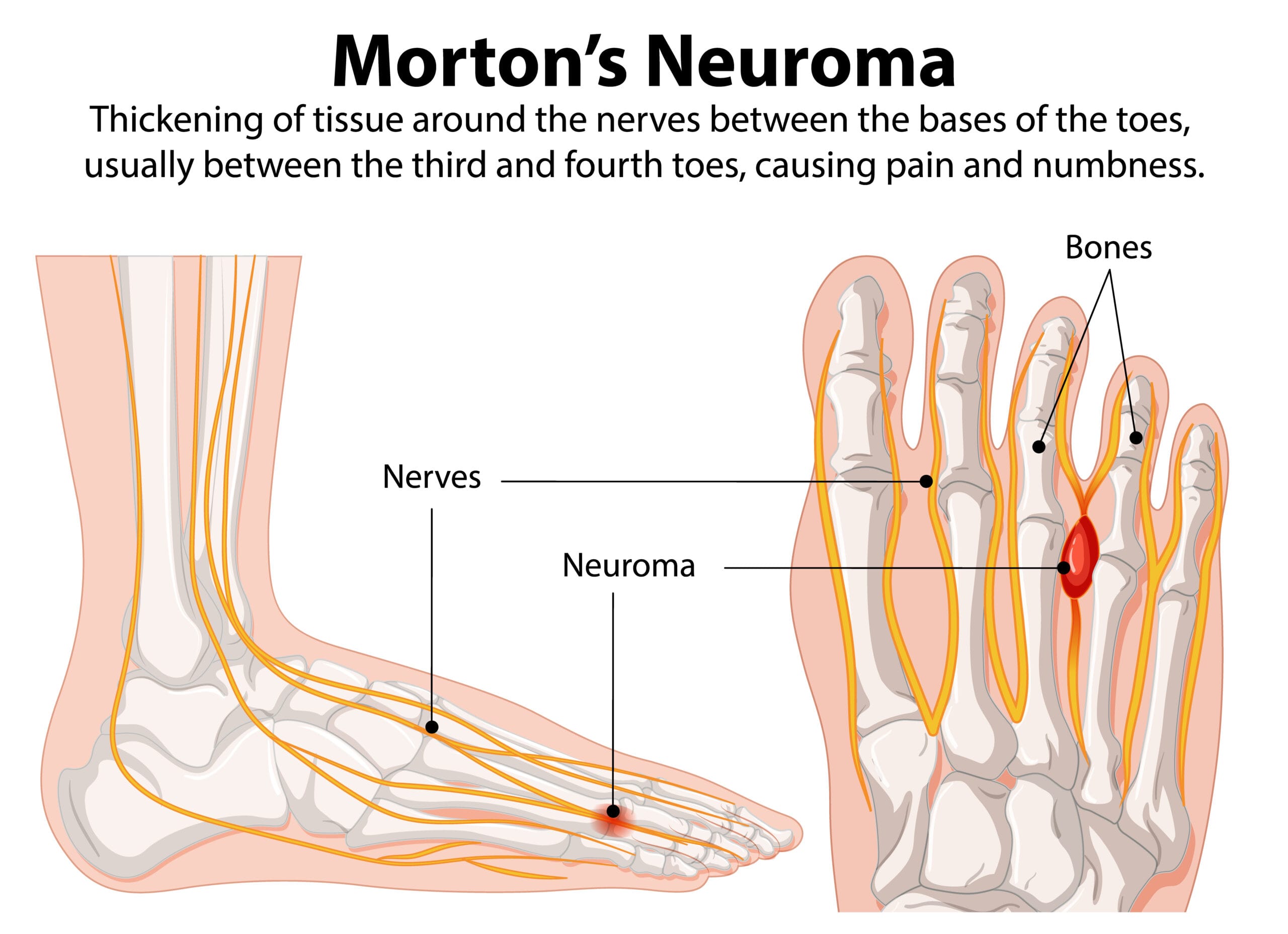 morton's neuroma